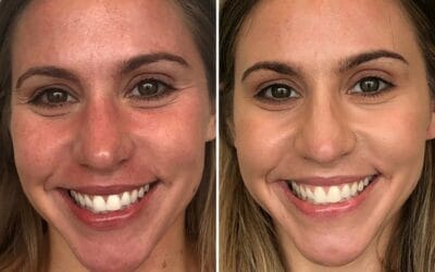 Baby Botox avant et après : Que dois-je savoir ?